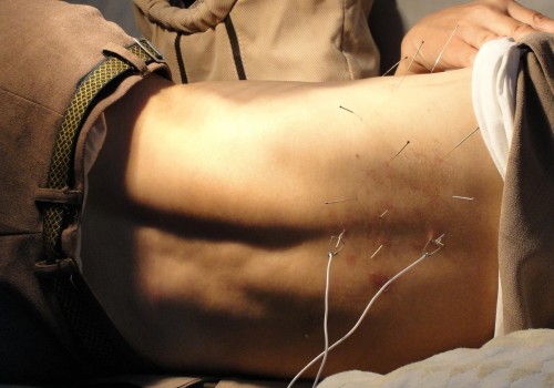 Discover Electroacupuncture Benefits in Portland